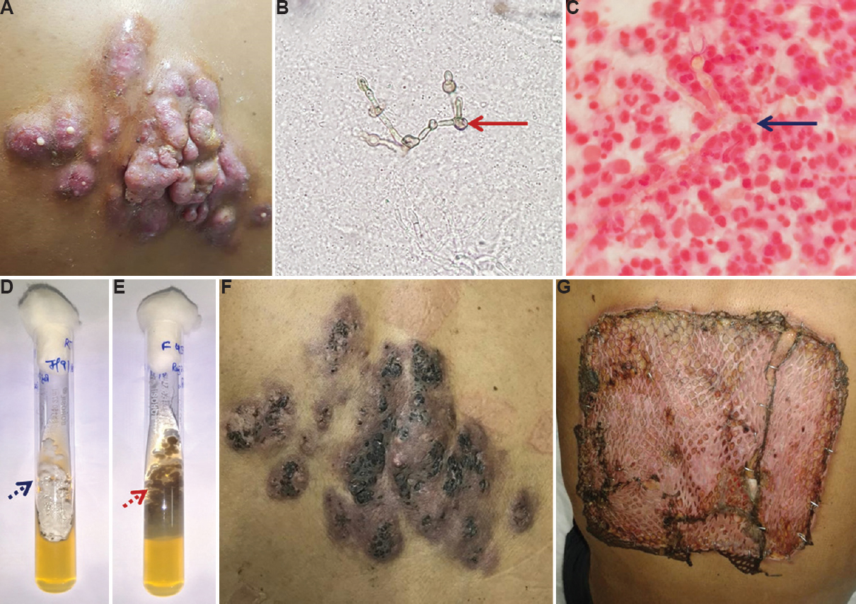 (A) Multiple, violaceous nodules with discharging sinuses over the inter-scapular area (at presentation). (B) KOH wet mount (×40) showing pigmented, septate, branching fungal hyphae with hyphal swellings (solid red arrow). (C) Gram stain (×100) showing septate, branching fungal hyphae with hyphal swellings (solid blue arrow). (D) Obverse of tube culture on Sabouraud dextrose agar showing black mycelial fungus (dotted blue arrow). (E) Reverse of the Sabouraud dextrose agar tube showing black mycelial fungus (dotted red arrow). (F) Lesion after three months of itraconazole therapy. (G) Skin grafting on the third post-operative day.